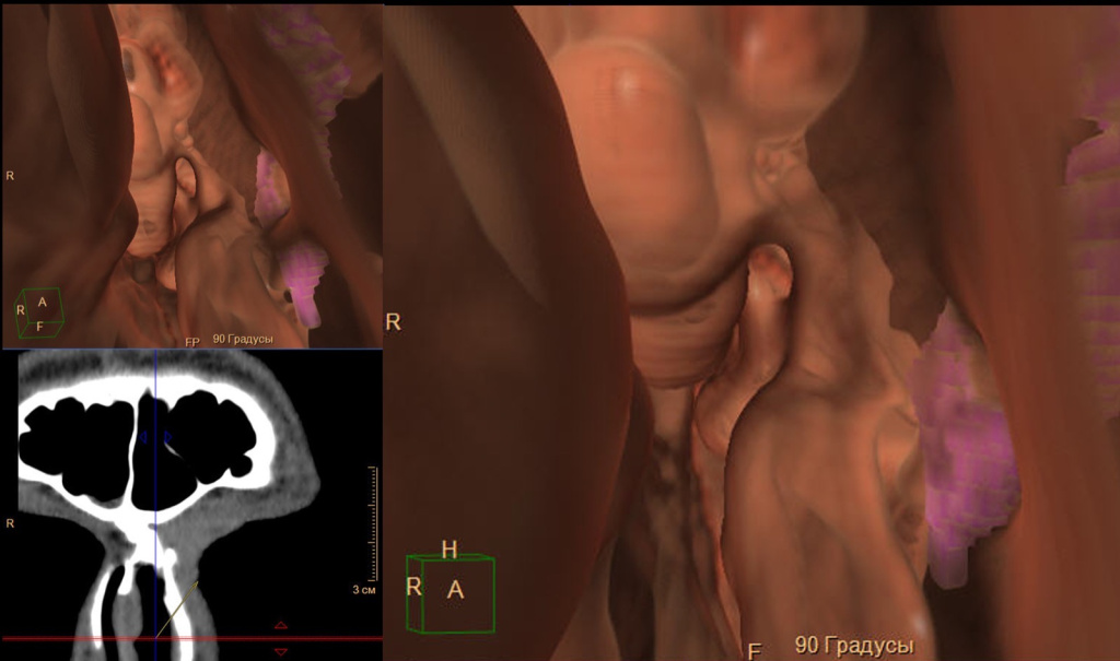 вирутальная эндоскопия с визуализацией слезоотводящих путей