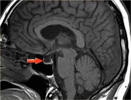 mri _gipofis.jpeg mri _gipofis.jpeg